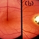 Macular coloboma